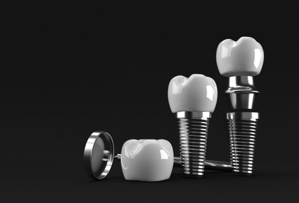 Cmimet me te mira per implante dentare ne Shqiperi