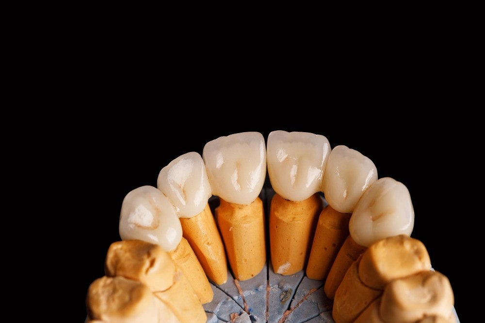 Kurora dentare porcelani në Shqipëri, kurora zirkoni me çmime ekonomike