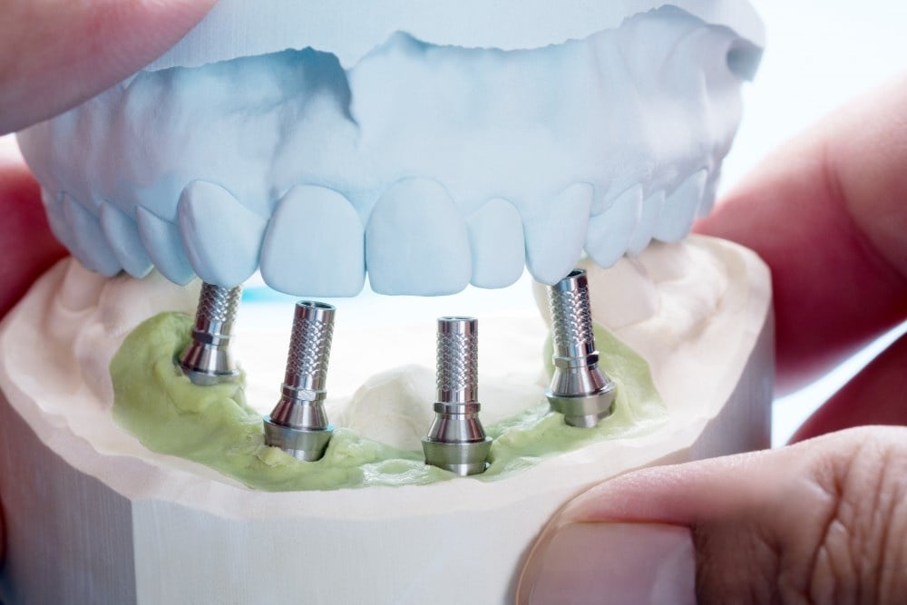 implante dentare brenda dites ne Shqiperi